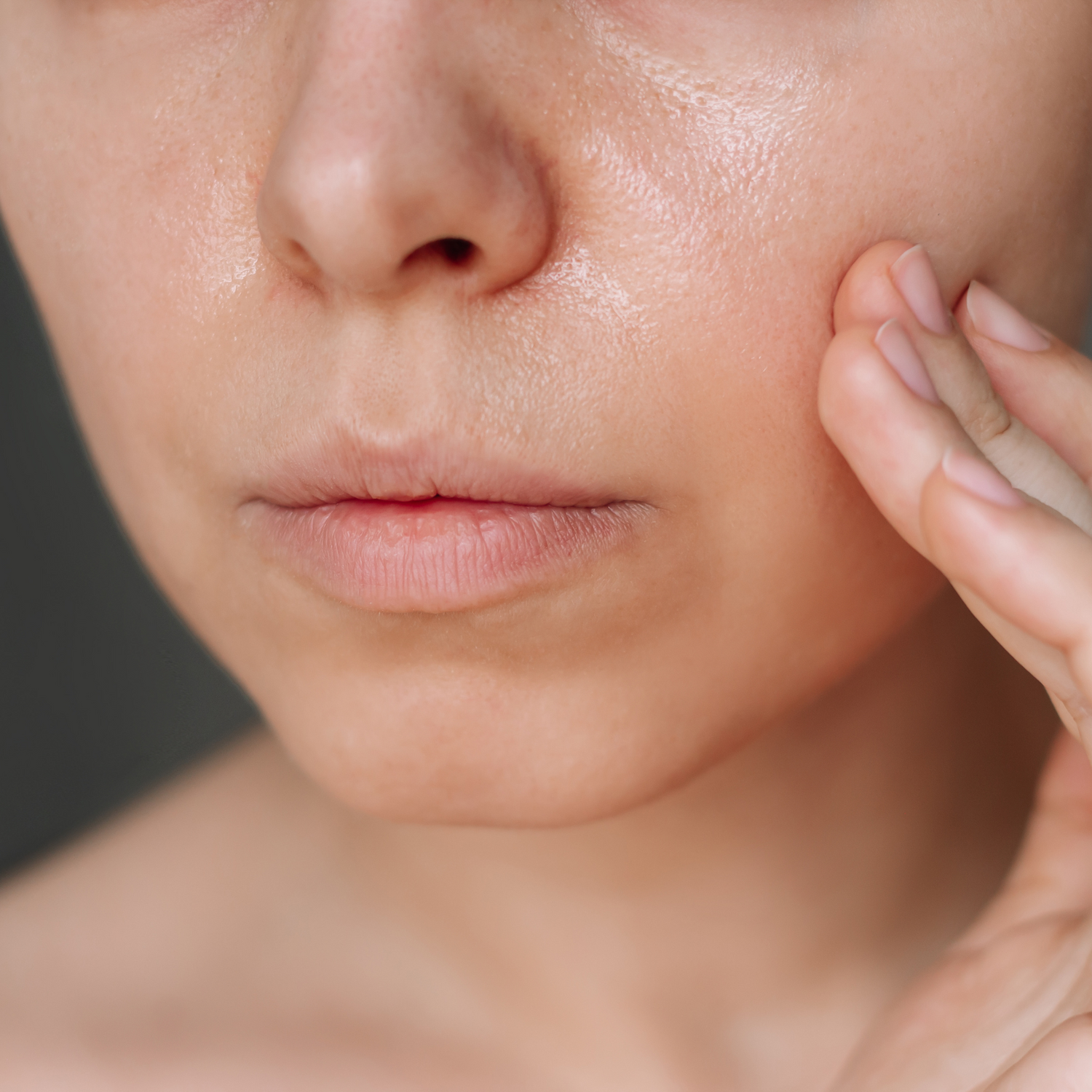 Close-up Fettige Haut bei einem Frauen Gesicht